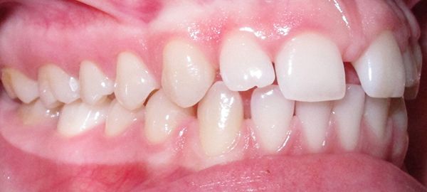 Ortodoncia Adultos - Ejemplo 6 - Antes