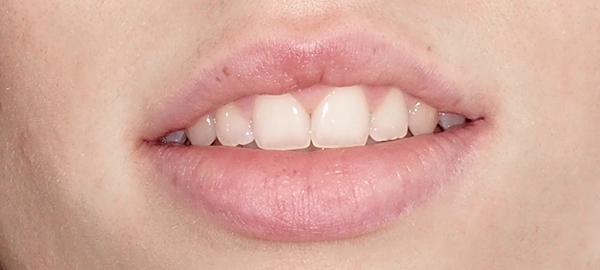 Ortodoncia Adultos - Ejemplo 6 - Después