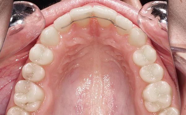 Ortodoncia Adultos - Ejemplo 6 - Después