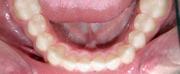 Ortodoncia Adultos - Ejemplo 7 - Antes