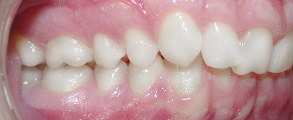 Ortodoncia Adultos - Ejemplo 7 - Antes