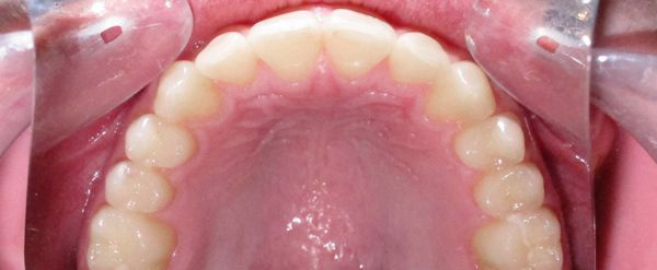 Ortodoncia Adultos - Ejemplo 7 - Después