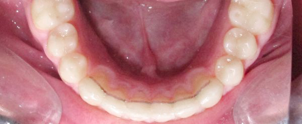 Ortodoncia Adultos - Ejemplo 7 - Después