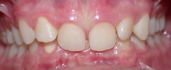 Ortodoncia Adultos - Ejemplo 8 - Antes