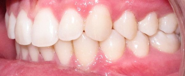 Ortodoncia Adultos - Ejemplo 8 - Después