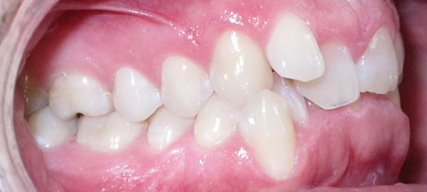 Ortodoncia Adultos - Ejemplo 9 - Antes