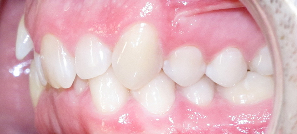 Ortodoncia Adultos - Ejemplo 9 - Antes