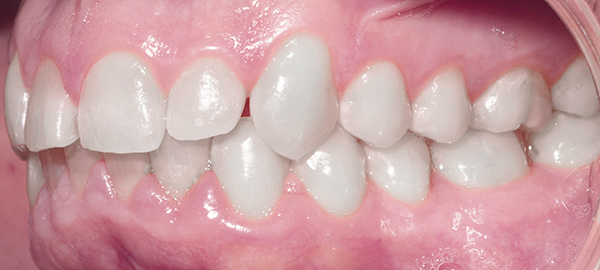 Ortodoncia Adultos - Ejemplo 9 - Después