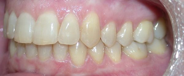 Ortodoncia Adultos - Ejemplo 10 -  Después