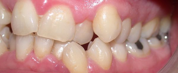 Ortodoncia Adultos - Ejemplo 11 - Antes
