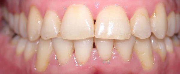 Ortodoncia Adultos - Ejemplo 11 - Después