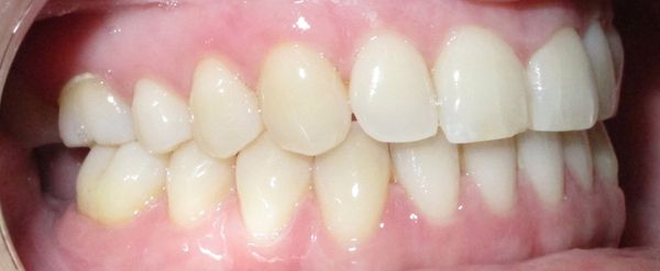 Ortodoncia Adultos - Ejemplo 12 - Después