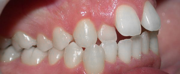 Ortodoncia Adultos - Ejemplo 13 - Antes