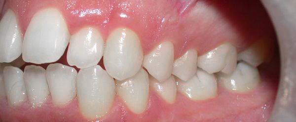 Ortodoncia Adultos - Ejemplo 13 - Antes