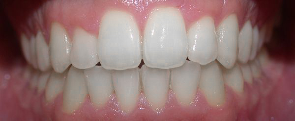 Ortodoncia Adultos - Ejemplo 13 - Después