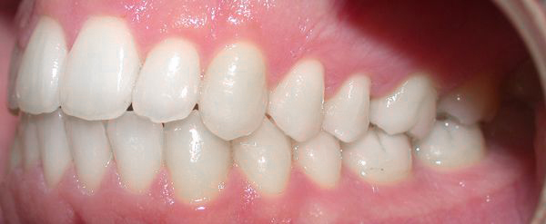 Ortodoncia Adultos - Ejemplo 13 - Después