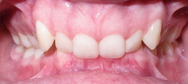 Ortodoncia y Cirugía - Ejemplo 01 - Antes