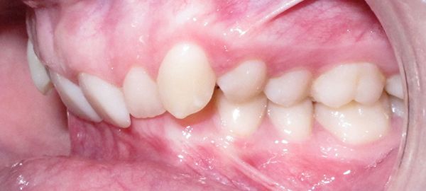 Ortodoncia y Cirugía - Ejemplo 01 - Antes